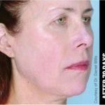 Ultherapy Before & After Patient #1550